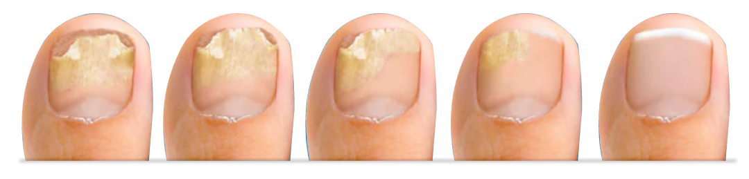 elimina el hongo en las uñas y recupera su forma y color natural