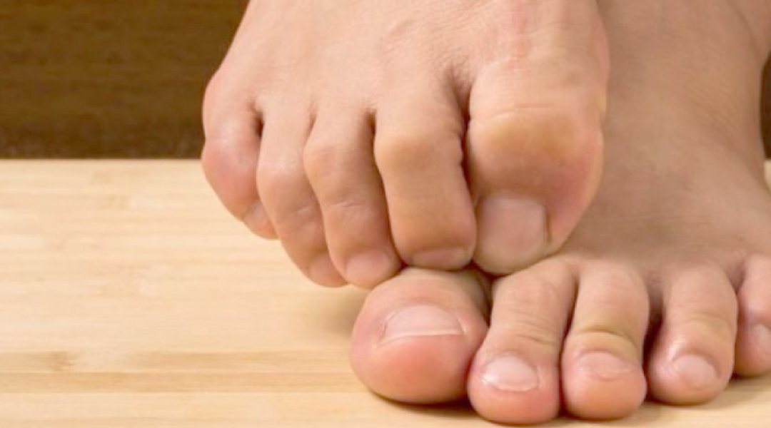 Hongos en los pies y como combatirlos efectivamente
